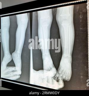 Plain x Ray PXR of right and left feet, ankles and legs of skeletally immature male patient child 18 months 2 views fixed by parent hands showing norm Stock Photo