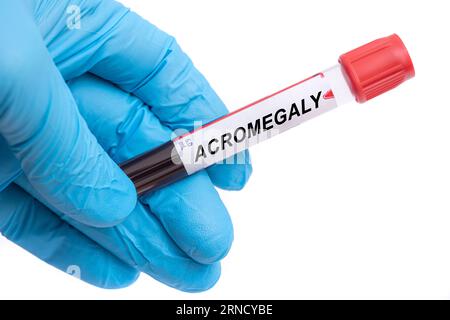 Acromegaly. Acromegaly disease blood test in doctor hand Stock Photo
