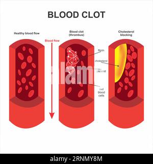 Blood clot and cholesterol block illustration Stock Photo