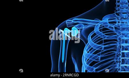 Shoulder replacement, illustration Stock Photo