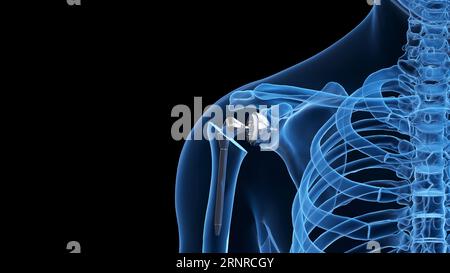 Shoulder replacement, illustration Stock Photo