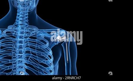 Shoulder replacement, illustration Stock Photo