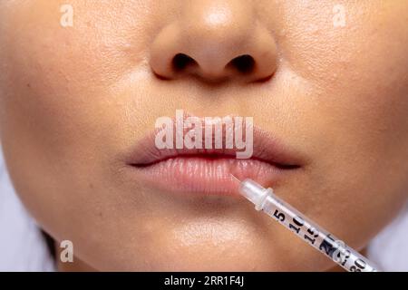 Close up of the lips of asian woman having collagen filler injection Stock Photo