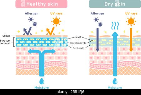 Comparison illustration of healthy skin and dry skin (cross section of skin) Stock Vector