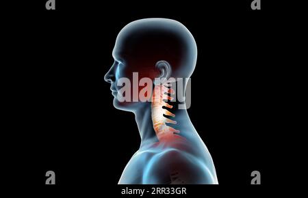 Side view of cervical section of spine injury and pain on black ...