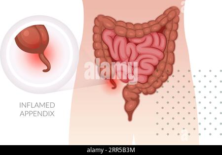 Appendicitis - Inflamed Appendix - Stock Illustration as EPS 10 File ...