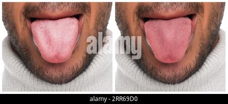 Collage with photos of man before and after lips augmentation on white ...