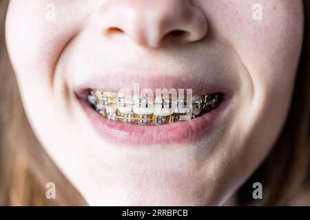 front view of dental brackets on teeth of teenager girl close up Stock Photo