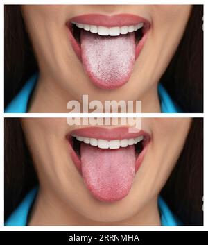 Collage with photos of woman before and after tongue cleaning, closeup Stock Photo