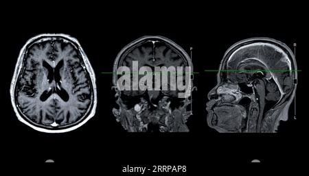 MRI brain scan Sagittal and coronal view with reference line for detect ...