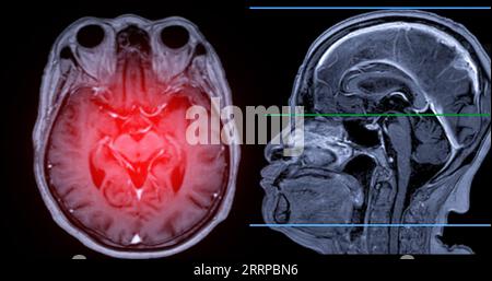 MRI brain scan Axial and sagittal view with reference line for detect ...