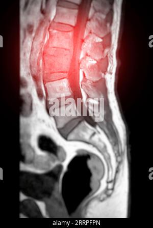 MRI L-S spine or lumbar spine sagittal T1 technique for diagnosis spinal cord compression. Stock Photo