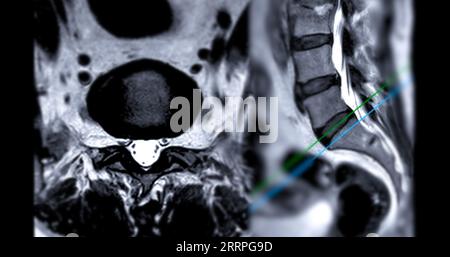 MRI L-S spine or lumbar spine Axial and sagittal T2 technique with reference line  for diagnosis spinal cord compression. Stock Photo