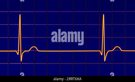 Junctional rhythm of the heartbeat, illustration Stock Photo - Alamy