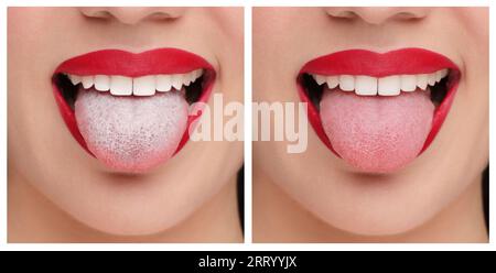 Collage with photos of woman before and after tongue cleaning, closeup Stock Photo