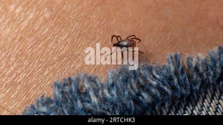 Infected female deer tick on hairy human skin. Ixodes ricinus. Parasitic mite. Acarus. Dangerous biting insect on background of epidermis detail. Disg Stock Photo