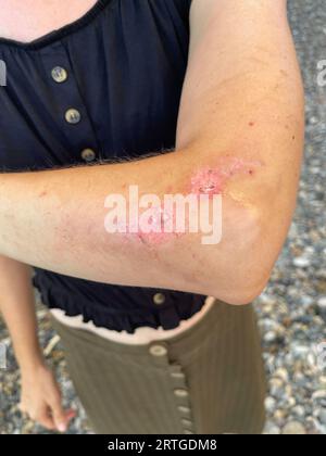 Woman with a scar on her arm after car accident Stock Photo