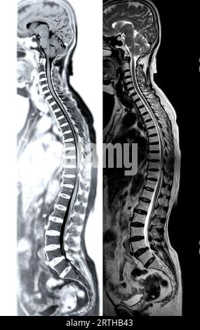 MRI whole spine screening for diagnosis spinal cord compression. Stock Photo