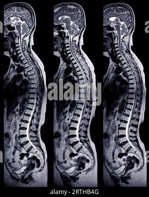 MRI whole spine screening for diagnosis spinal cord compression. Stock Photo