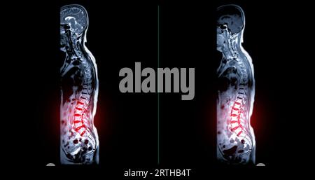 MRI whole spine screening for diagnosis spinal cord compression. Stock Photo