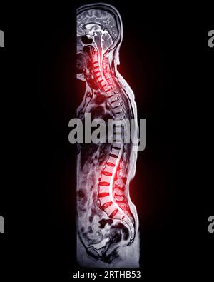 MRI whole spine screening for diagnosis spinal cord compression. Stock Photo