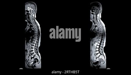 MRI whole spine screening for diagnosis spinal cord compression. Stock Photo