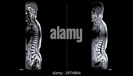 MRI whole spine screening for diagnosis spinal cord compression. Stock Photo