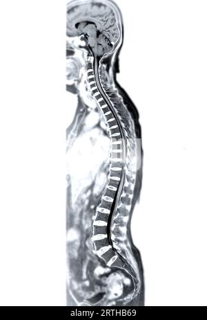 MRI whole spine screening for diagnosis spinal cord compression. Stock Photo