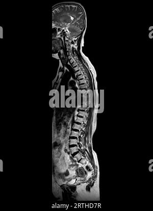 MRI whole spine screening for diagnosis spinal cord compression. Stock Photo