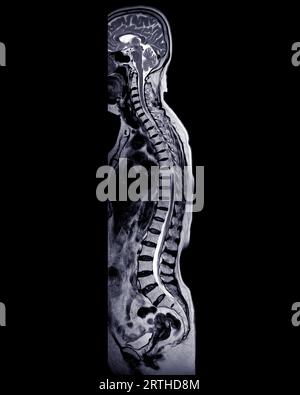 MRI whole spine screening for diagnosis spinal cord compression. Stock Photo