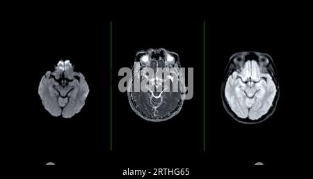 MRI brain scan axial Diffusion technique for detect Brain diseases sush ...