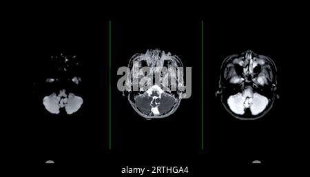 MRI brain scan axial Diffusion technique for detect Brain diseases sush ...