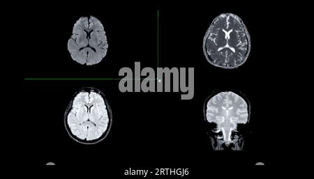 MRI brain scan axial Diffusion technique and coronal gredient for ...