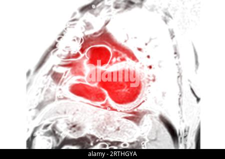 MRI heart or Cardiac MRI ( magnetic resonance imaging ) of heart Short axis view for diagnosis heart disease. Stock Photo