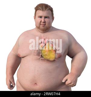 Overweight man with enlarged heart, illustration Stock Photo