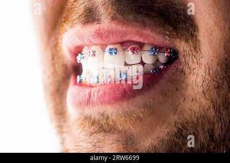 Man braces. Teeth braces on the white teeth of man to equalize the teeth. Bracket system in smiling mouth, macro photo teeth, close-up lips, macro Stock Photo