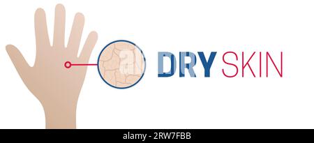 Dry Skin Medical Style Background Illustration Design Stock Vector