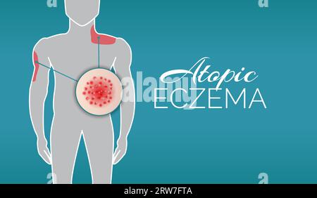 Atopic Eczema Background Illustration Banner with Woman Stock Vector ...