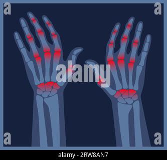 Rheumatoid Arthritis hands. Pain in the human body. Arthritis, bone ...