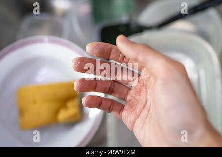 Hand with peeling skin because of dish washing Stock Photo