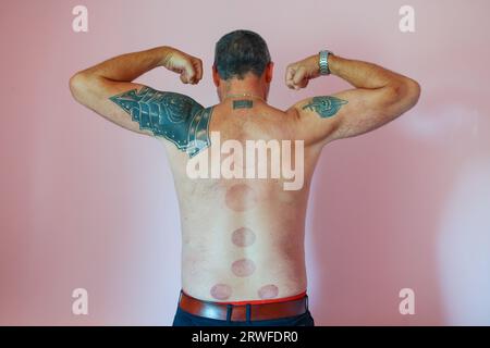 marks on the male back from cupping massage Stock Photo