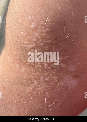 Close up on blistered skin damaged by sun exposure. Stock Photo