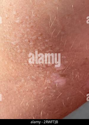 Close up on blistered skin damaged by sun exposure. Stock Photo