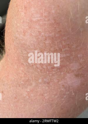 Close up on blistered skin damaged by sun exposure. Stock Photo