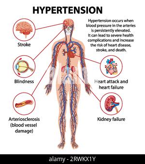 Illustrated infographic explaining how hypertension impacts various parts of the human body Stock Vector