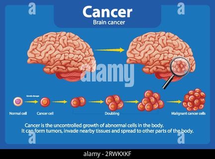 Illustrated guide to brain cancer and abnormal cell growth Stock Vector ...
