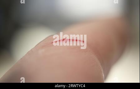 Cut with blood on the skin closeup Stock Photo