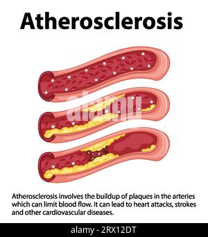 Infographic on heart health and cardiovascular disease risks Stock Vector