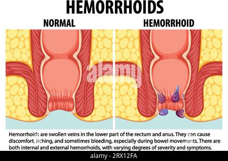 Learn about the differences between normal and internal hemorrhoids through an educational infographic Stock Vector