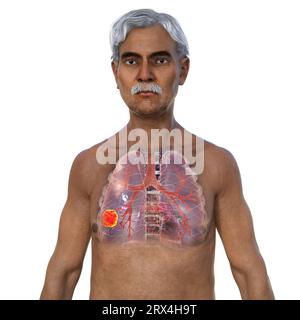 Lungs affected by lung cancer, illustration Stock Photo - Alamy